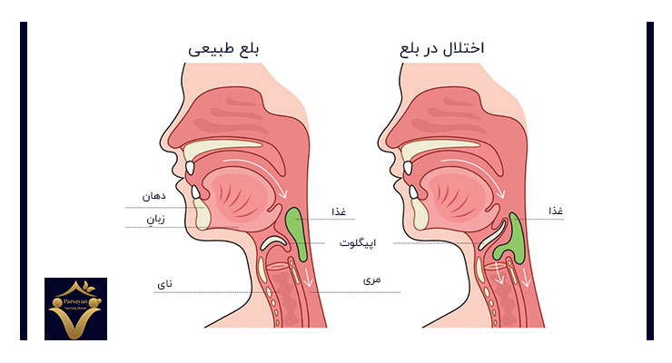 اختلال در بلع